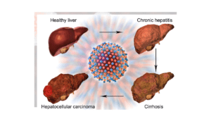 fatty liver disease