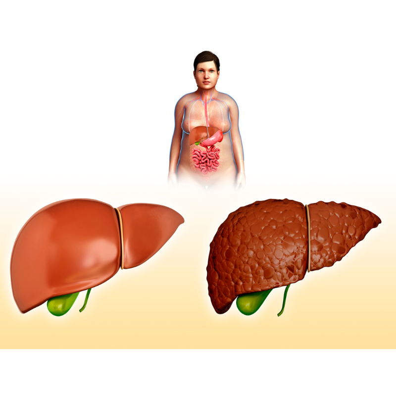 healthy and fatty liver